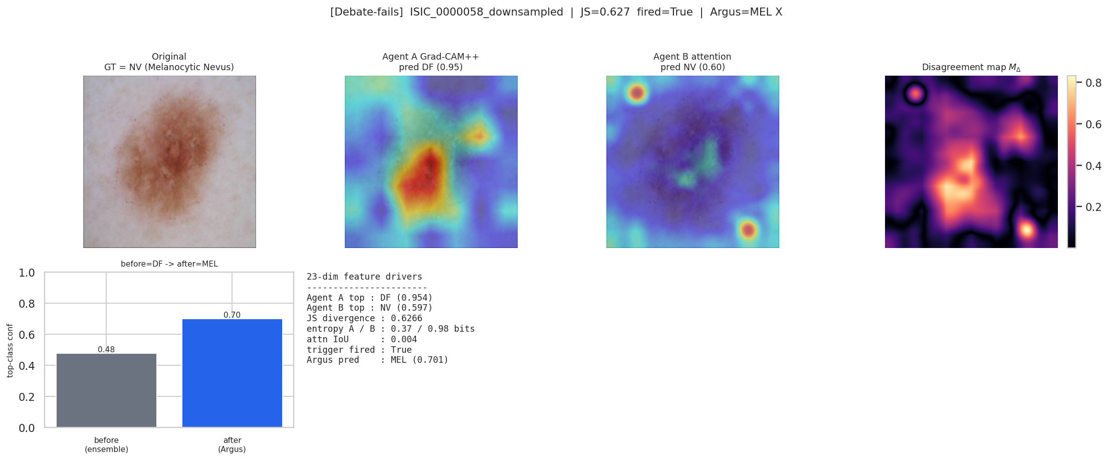 Test case ISIC_0000058 where Argus consensus outputs a misclassification.