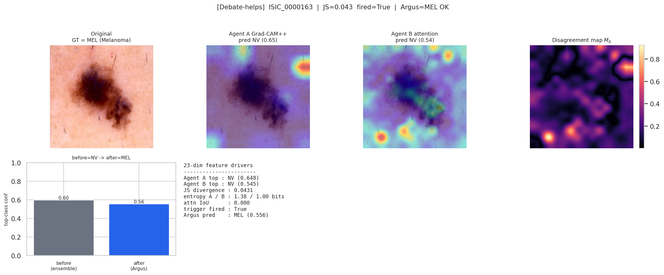 Test case ISIC_0000163 where Argus arbitration changes prediction to Melanoma.